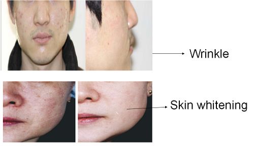 Micro-needle RF Acne Scar Removal Machine Micro-needle RF Acne Scar Removal Machine
