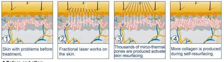CO2 Fractional Laser Anti-aging Machine