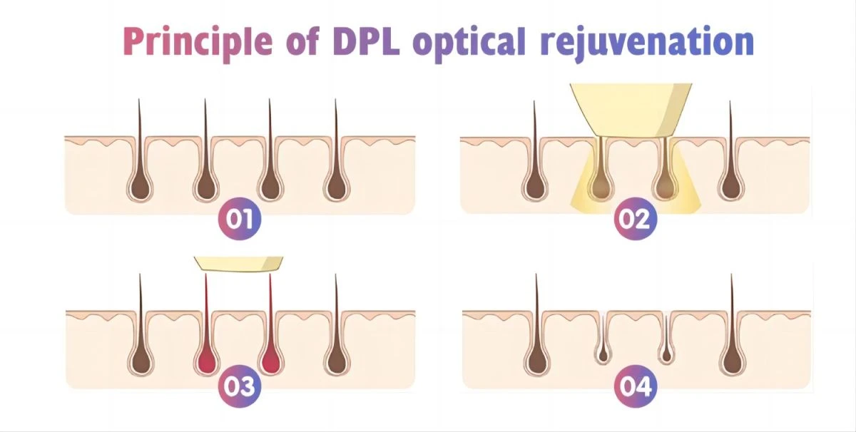 Dpl IPL Laser Hair Removal Equipment Cost High Quality Commercial Use OEM Aesthetics Painless Hair Removal Dpl IPL Laser Hair Removal Equipment Cost High Quality Commercial Use OEM Aesthetics Painless Hair Removal1