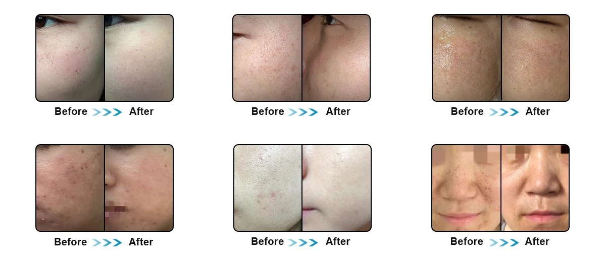 Multi-function Hair Removal Skin Rejuvenation Machine DPL Multi-function Hair Removal Skin Rejuvenation Machine DPL